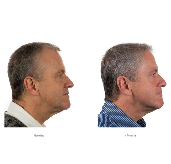 FOLIGAIN Triple Action Shampoo For Thinning Hair For Men with 2% Trioxidil - FOLIGAIN EUROPE