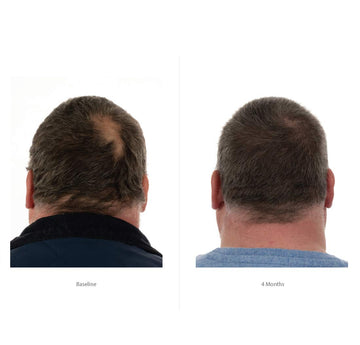 Future Trends in Hair Loss Treatment and Prevention